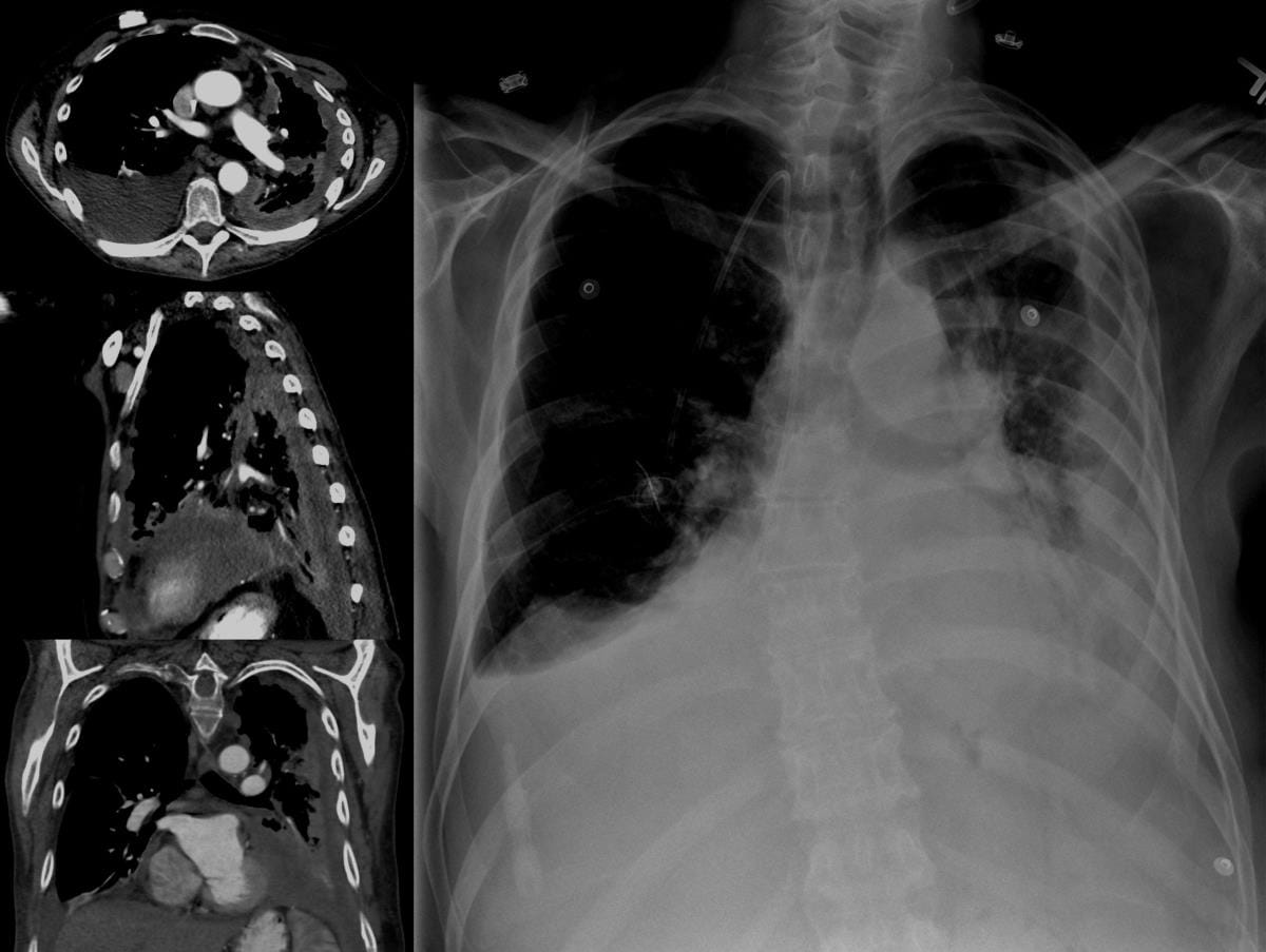 Claims For Mesothelioma